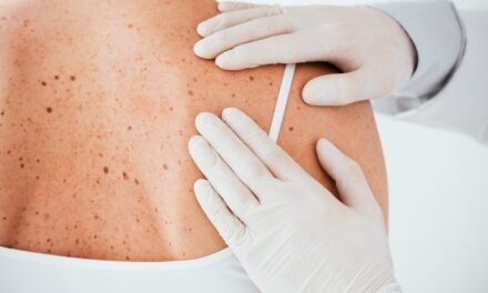 Z jakimi zmianami skórnymi trzeba udać się do dermatologa?